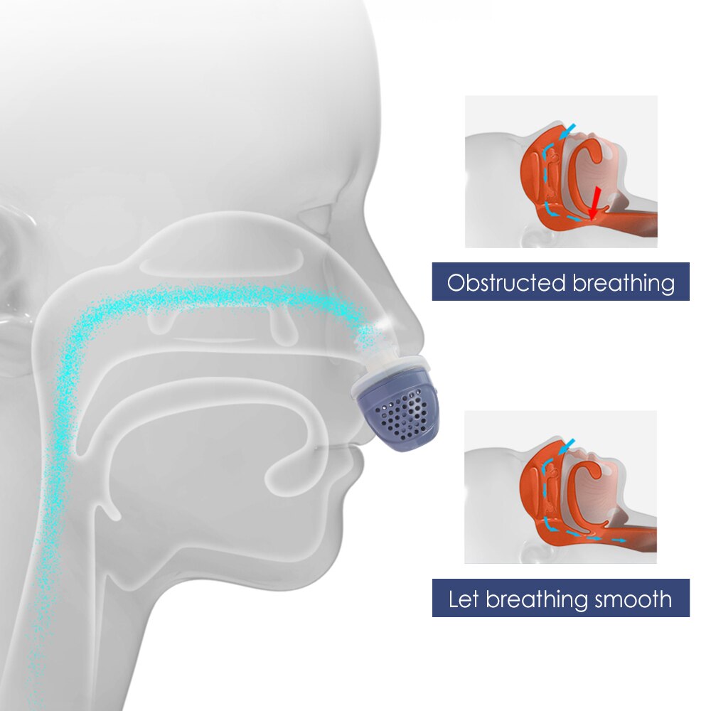 SleepWell™ Electric Anti Snoring Device